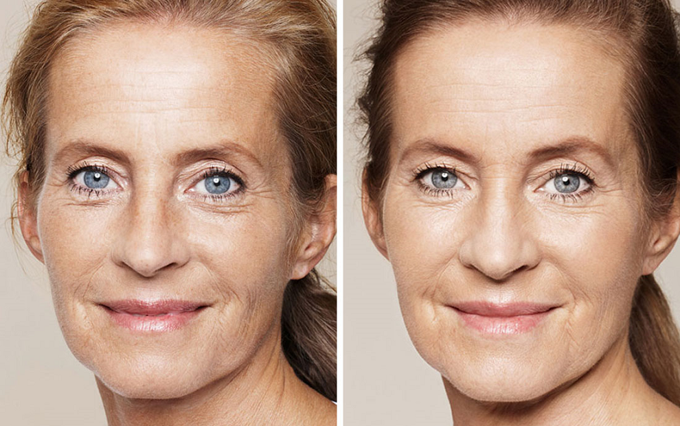 Типы старения кожи и процедуры способные их скорректировать | клиника "отражение"
